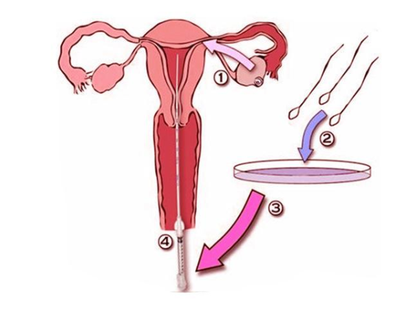 人工授精怎样取精子呢？