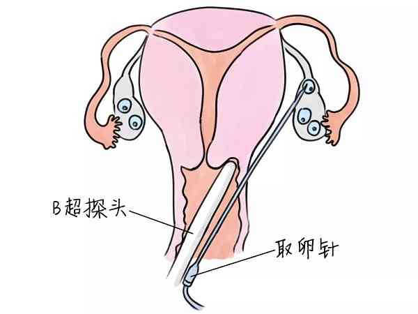 腹部取卵手术前后注意事项