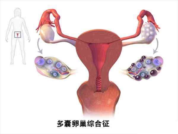 为什么多囊怀孕容易胎停？
