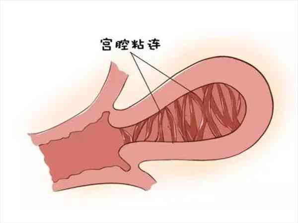宫腔粘连最明显的症状是什么？