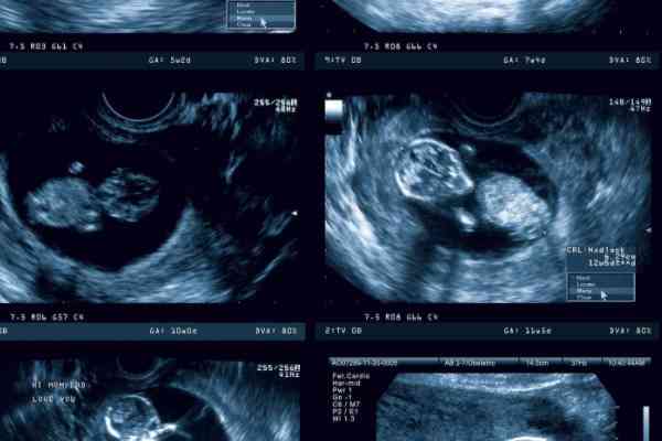 单卵双胎减胎能减一个吗？