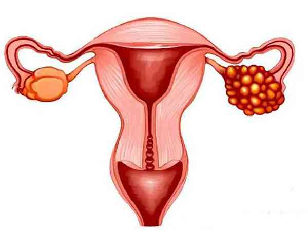 卵巢afc大于10是多囊吗？