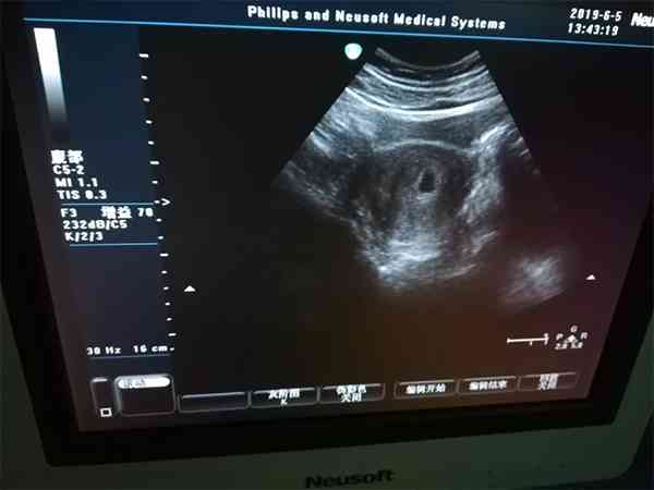怀孕30天的孕囊图可以看出男女吗？