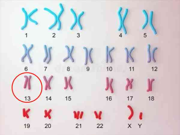13号染色体异常是怎么造成的？