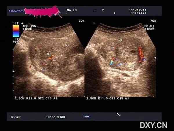 太早孕检会误诊宫角妊娠？