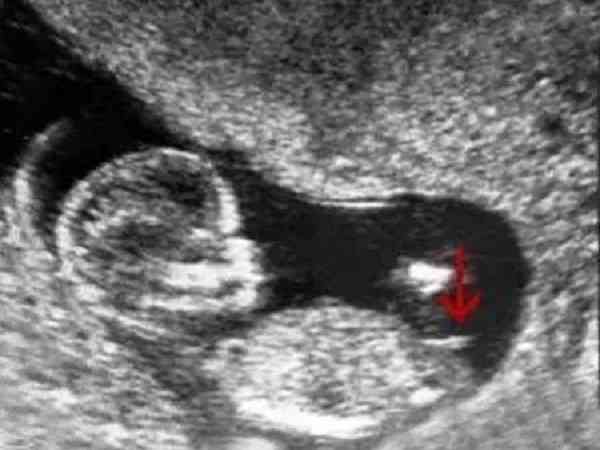 孕检b超胎儿腿短是男孩还是女孩？