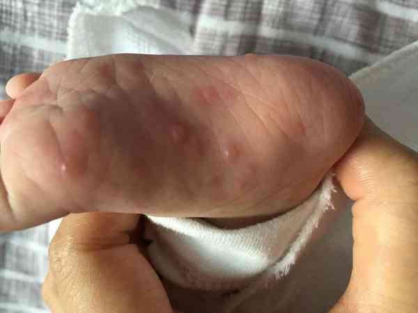 小儿水痘初期自愈最快的一种方法是什么？