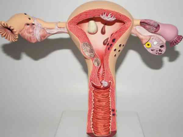 子宫内膜异位症试管成功案例