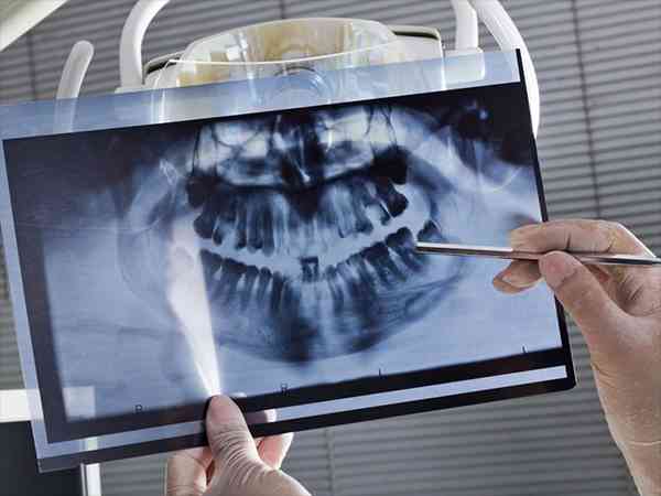 牙科x光多久可以试管移植？