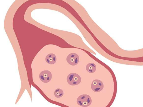 多囊卵巢患者的卵泡不能发育成熟