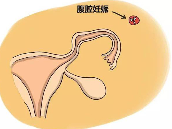 腹腔妊娠属于异位妊娠的一种