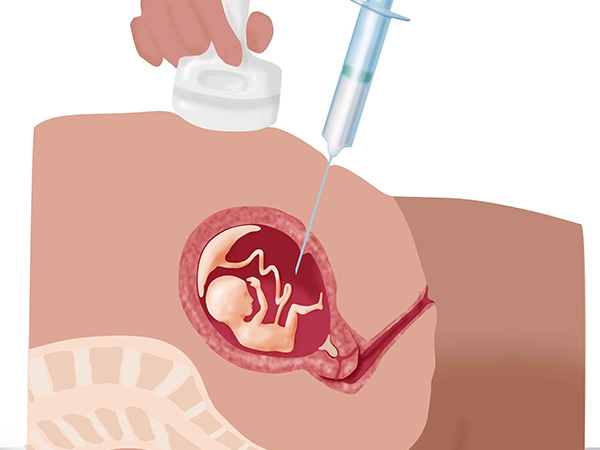 羊水穿刺检查