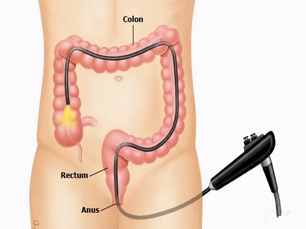 肠镜检查