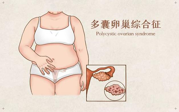 多囊卵巢促排前需要各项指标正常