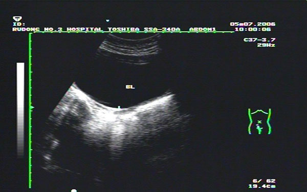 始基子宫超声诊断