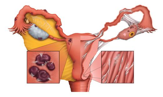 B超显示内膜中断大概率是宫腔粘连