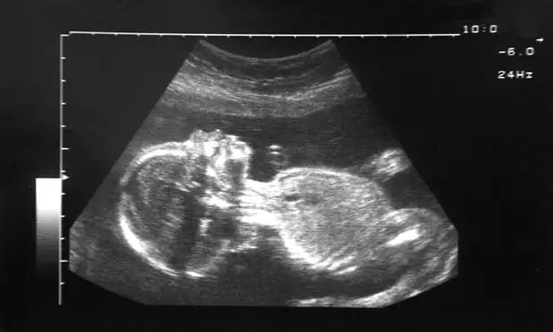 怀孕4个月通过B超检可以确定性别