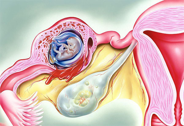 宫外孕能保留输卵管会尽量保留