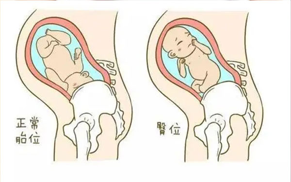 孕期不能通过臀位看男女