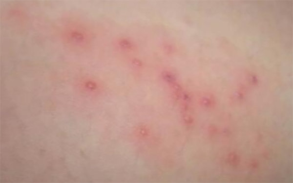 病毒疹症状全身弥漫性分布暗红色斑丘疹