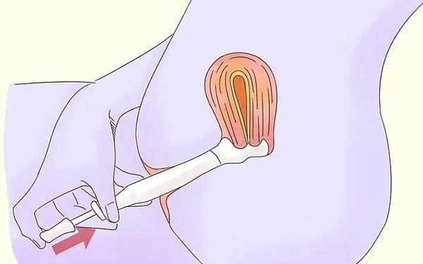 避孕药膜使用时需要塞入阴道深处