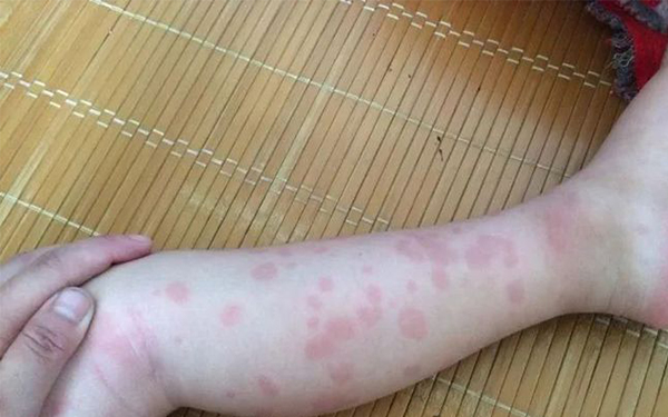幼儿急疹表现为玫瑰红色的斑丘疹