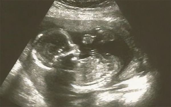 12周的女宝NT图脊柱线和生殖器节点处平缓