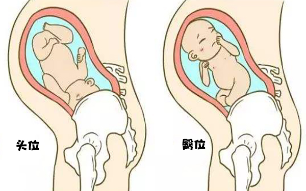 臀位分娩是有可能对胎儿造成影响的