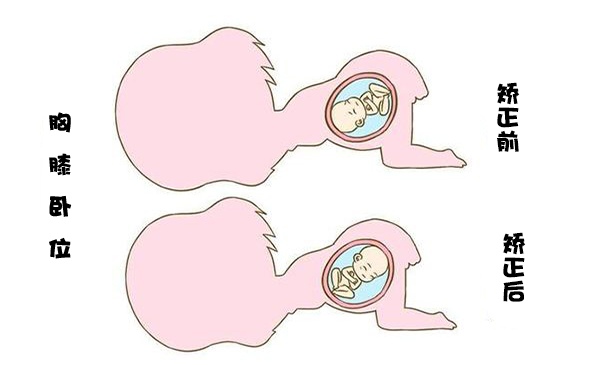 在臀位转成头位的过程中大多数孕妇是没有感觉的