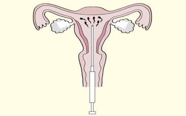 女性购买精子做人工授精需要1万元每周期