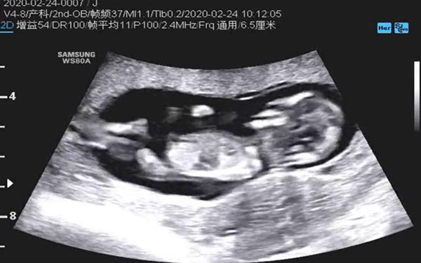 怀孕初期nub点和腿可以通过位置等区分
