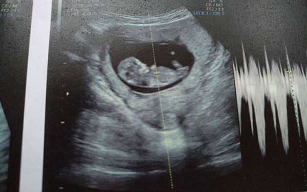 怀孕13周通过婴儿头臀径看男女是不准确的