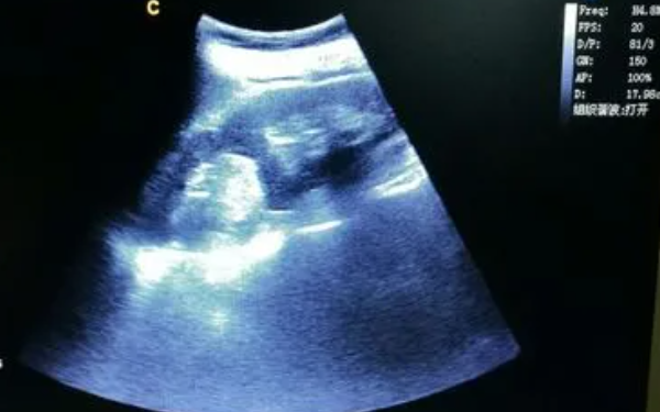 胎儿双顶径偏小两周是正常的