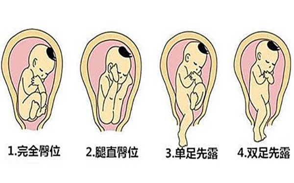 怀孕期间的臀位是由于羊水过多等原因