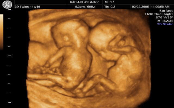 胎儿四维能看脸型