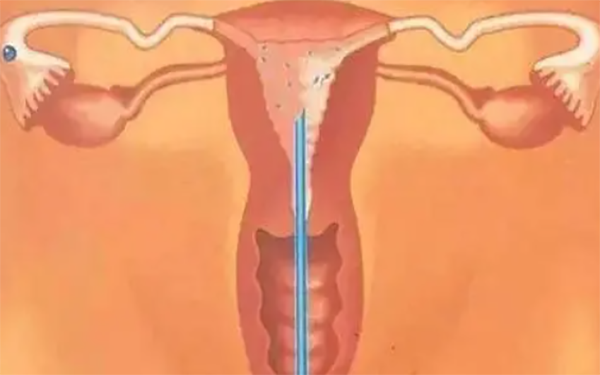 内膜a型和b型都不利于胚胎着床