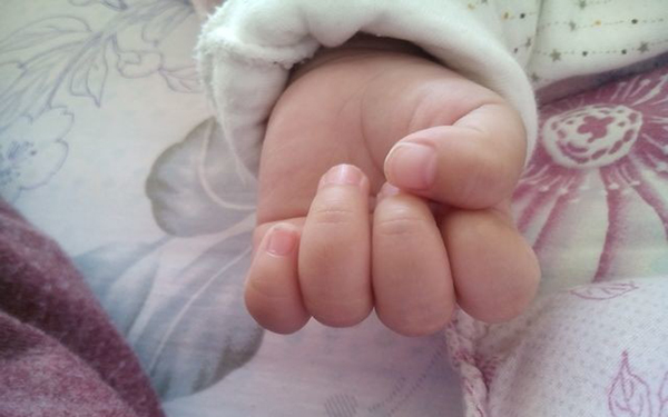宝宝拇指内扣不一定是脑瘫儿