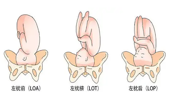 LOA表示胎方位是枕左前位