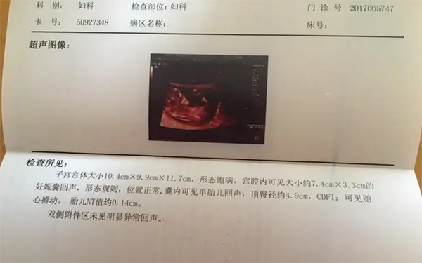 上海并没有全面取消孕期的NT检查