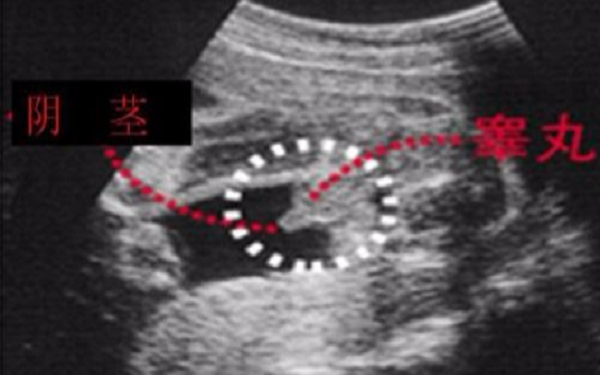 b超单子图片主要是看胎儿的生殖器