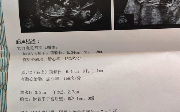 NT检查是无法判断胎儿性别