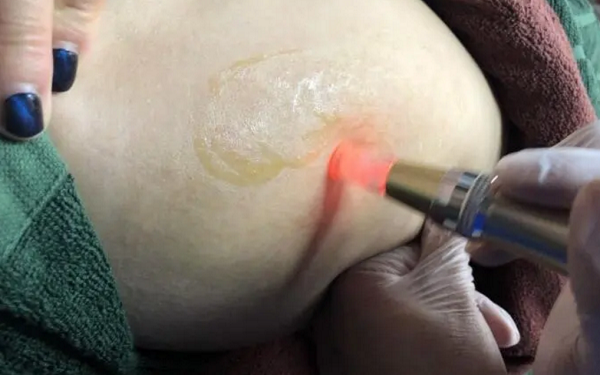 激光对于妊娠纹有不错的改善效果