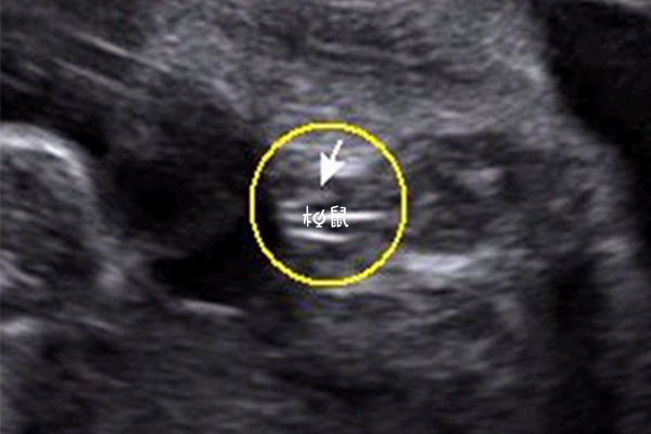 女孩的外生殖器在彩超下显示为三条线