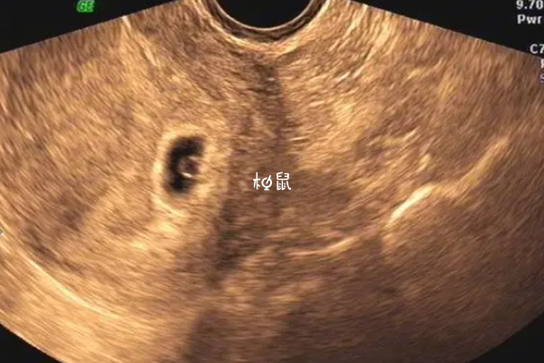 孕囊中间数据小也不一定是怀的男孩