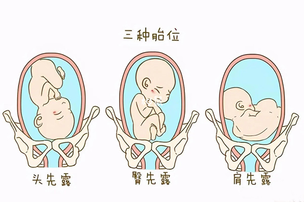 臀位分娩时是臀部或足部先娩出