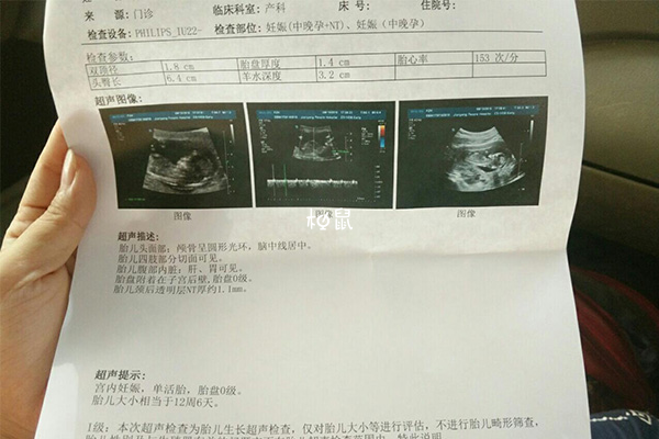 孕13周NT值小于1.4mm是女孩