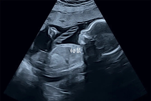 孕20周的胎儿身长为17厘米