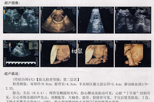 怀孕25周的胎儿如网纹瓜般大小