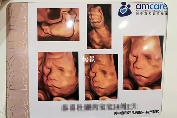 24周胎儿已经充满了子宫