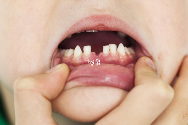 孩子一般中切牙线脱落